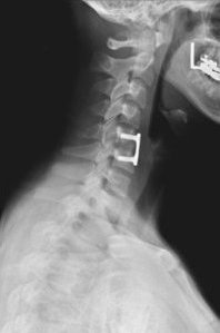 Historical infrared cervical medical image